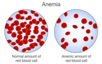 Kasusnya Langka Ditemukan, Ini Gejala-Pencegahan Anemia Aplastik